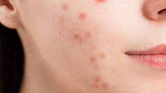 Acne e sole