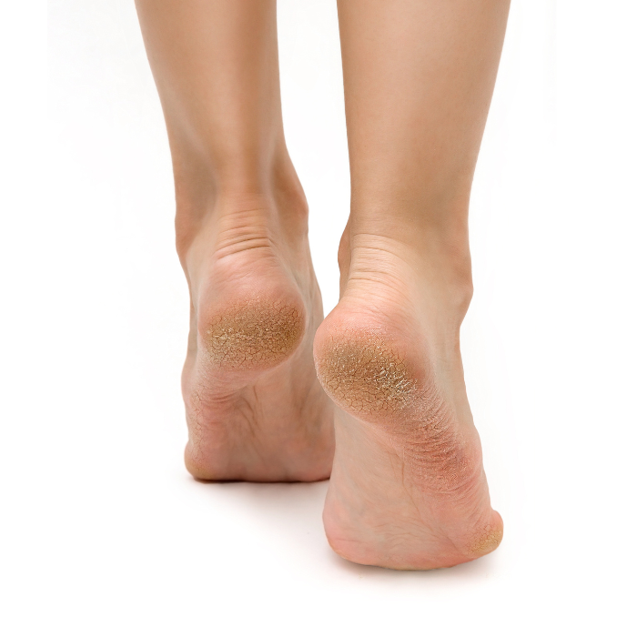 Feetcalm Spray Piedi per Calli e Duroni 20% Urea 75 ml