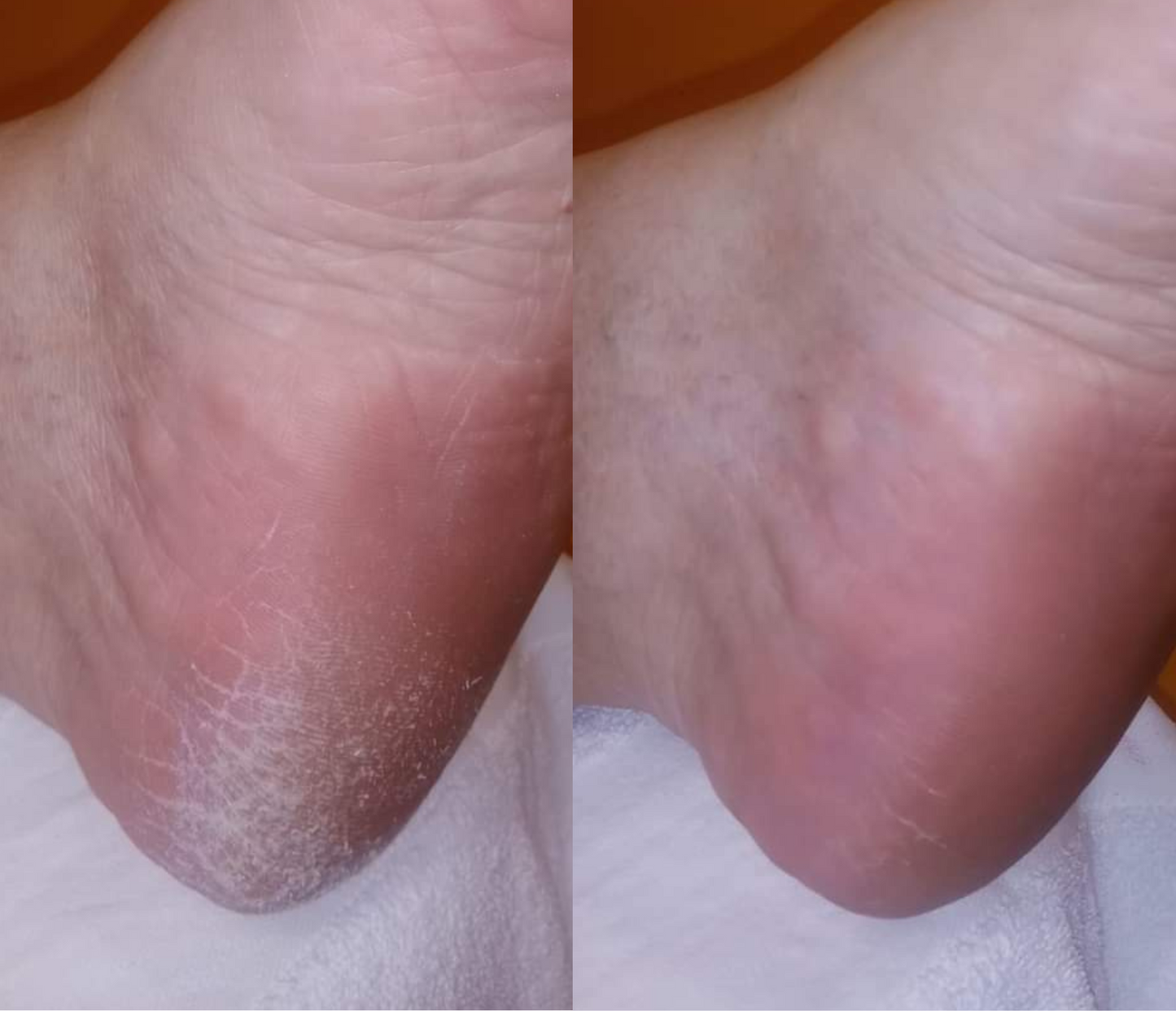 Feetcalm Spray Piedi per Calli e Duroni 20% Urea 75 ml