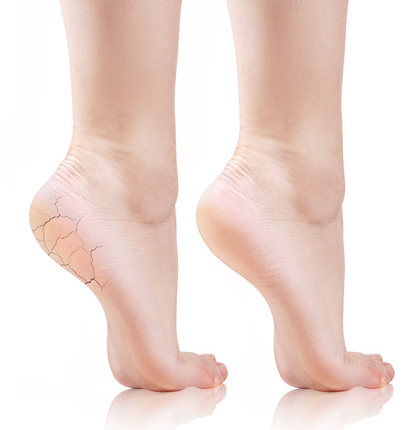 Feetcalm Mousse Piedi per Calli e Duroni 25% Urea 75 ml