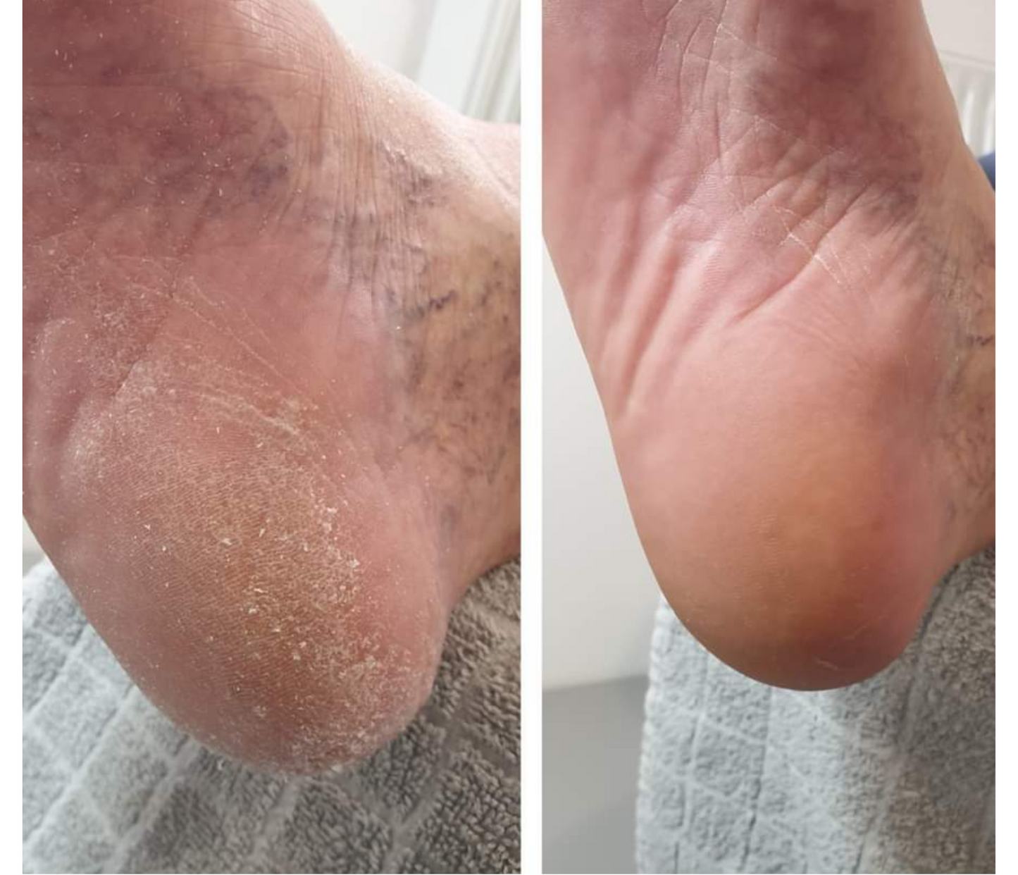 Feetcalm Mousse Ultra Idratante Piedi 15% Urea 125 ml